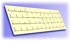 typical EKG