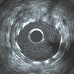 Intravascular ultrasound image of stent in artery